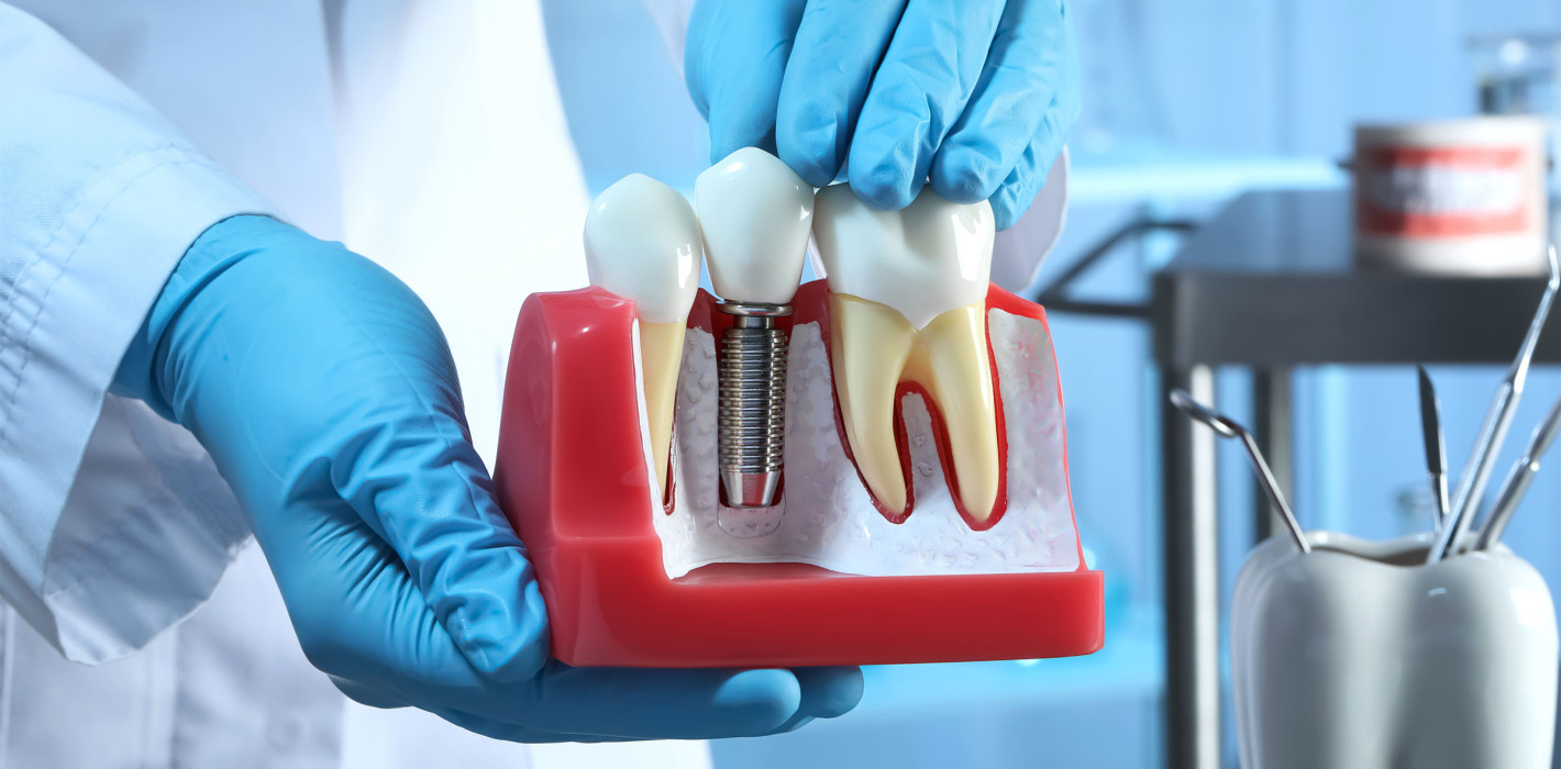 Strontium als Hilfsmittel bei der Implantateinheilung