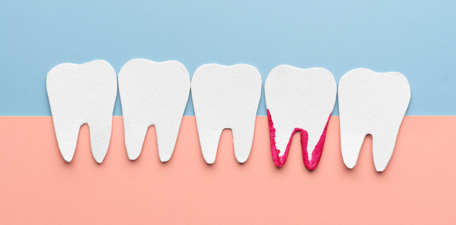 Langzeitstudie zeigt: Selbst “hoffnungslose“ Zähne lassen sich erhalten