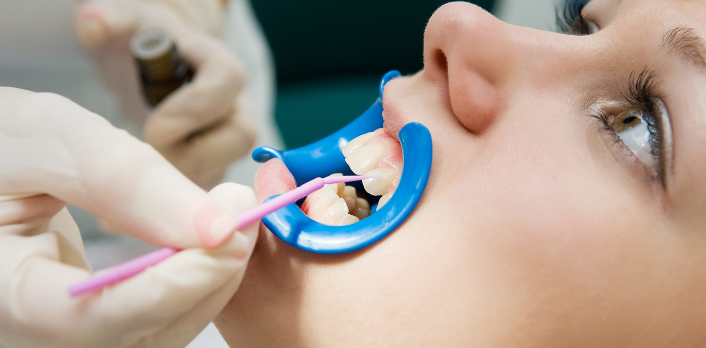 Approximalkaries: Topische Fluoride versus NaF-Lack