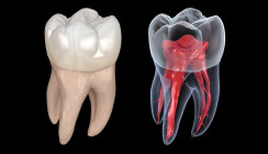 Wurzelbehandlung: Neuartige Analyse von Dentinoberflächen
