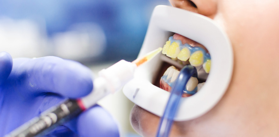 Studie zu Bleaching-Anwendungen mit Carbamidperoxid