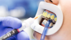 Studie zu Bleaching-Anwendungen mit Carbamidperoxid