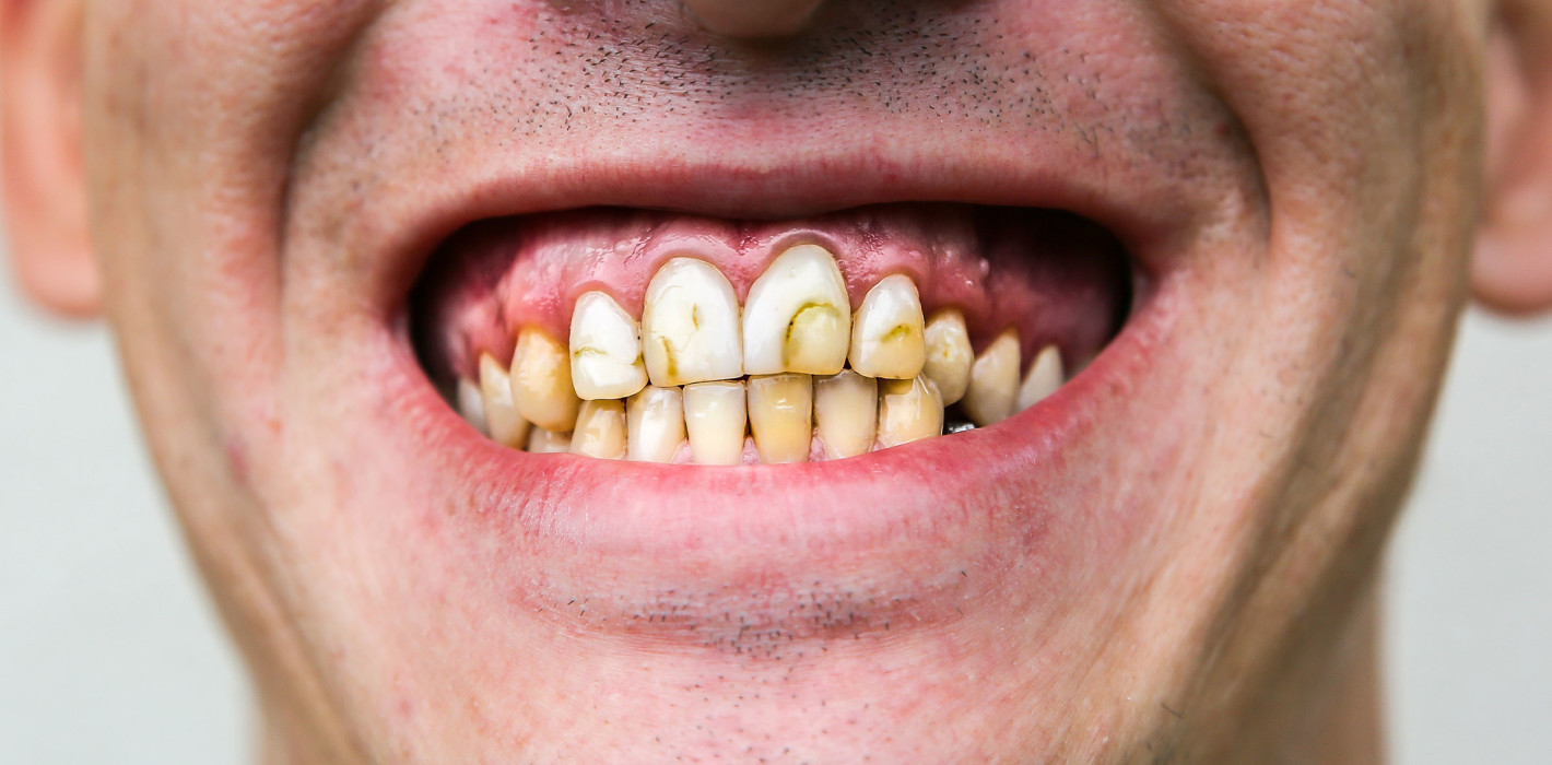Phänomen "Ozempic Teeth": Die Kilos purzeln, die Zähne gleich mit