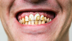 Phänomen "Ozempic Teeth": Die Kilos purzeln, die Zähne gleich mit