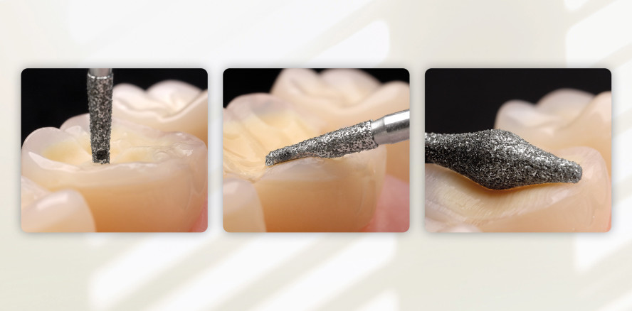 Step-by-Step: Okklusionsonlays – die Alternative zur Krone