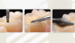 Step-by-Step: Okklusionsonlays – die Alternative zur Krone