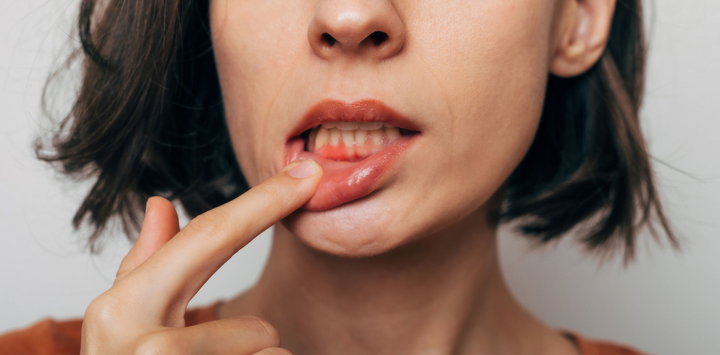 Neuer Test zur Früherkennung von Gingivitis