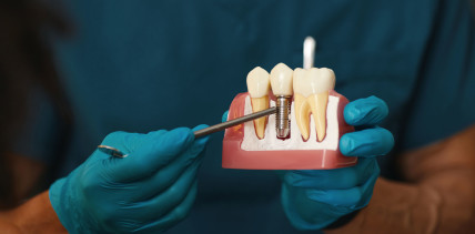 Unsichtbare Spuren: Titanpartikel um Implantate häufiger als gedacht