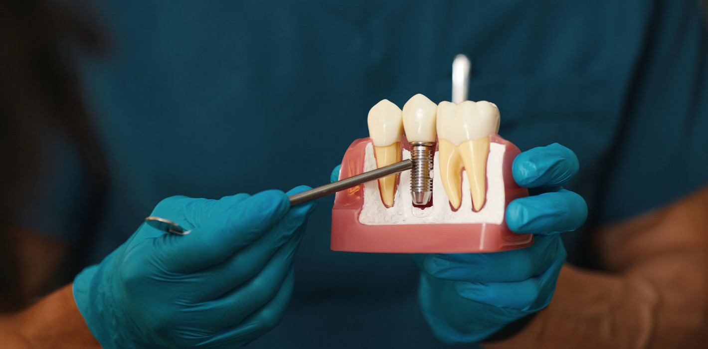 Unsichtbare Spuren: Titanpartikel um Implantate häufiger als gedacht