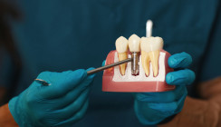 Unsichtbare Spuren: Titanpartikel um Implantate häufiger als gedacht