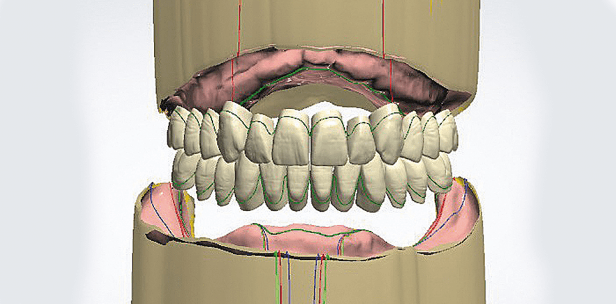 Digitale Totalprothetik