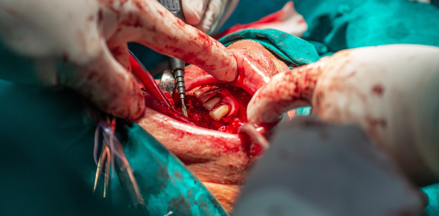 Seltener Tumor: Teenager werden 82 Zähne extrahiert