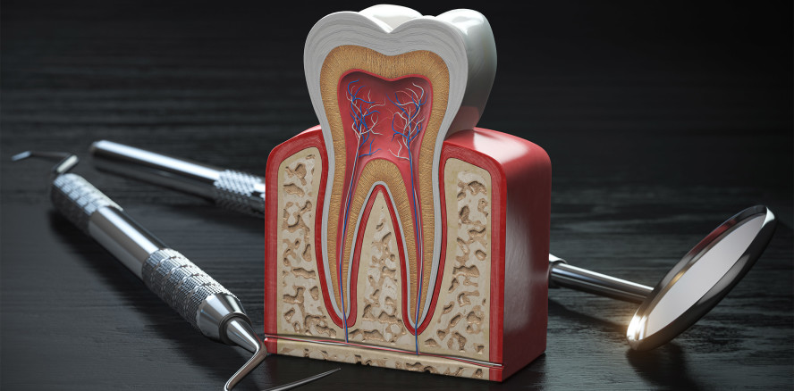 Analyse zur Überlebensdauer eines Zahns nach Wurzelkanalbehandlung