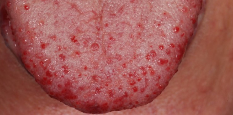 Umfrage zu seltenen Erkrankungen mit orofazialer Beteiligung