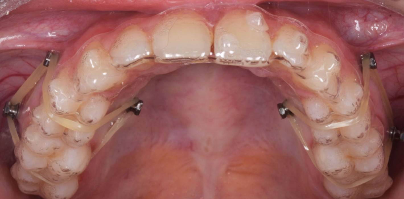Nachhaltige Behandlungsplanung mit dem FAS Aligner System