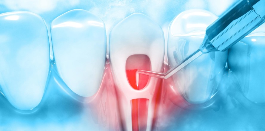 Zur Abrechenbarkeit von Leistungen im Rahmen einer Wurzelbehandlung