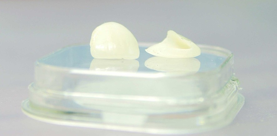 Veneers: Mode-Accessoire oder zahnmedizinisch sinnvoll?