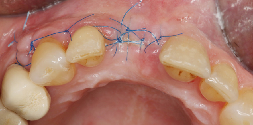 Vernetzte Hyaluronsäure in der Parodontologie und Oralchirurgie