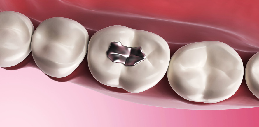 Aktionspläne zur Verringerung von Amalgam beschlossen