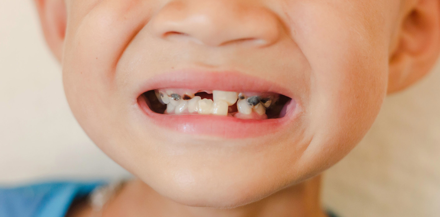 Bedingt Vitamin-D-Mangel das Kariesrisiko bei Kindern?