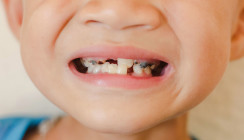 Bedingt Vitamin-D-Mangel das Kariesrisiko bei Kindern?