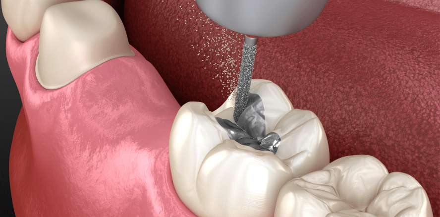 Die Bedeutung des Amalgamverbots für den zahnärztlichen Praktiker