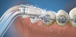Interdentalraumreinigung für unterschiedliche Patientenbedürfnisse