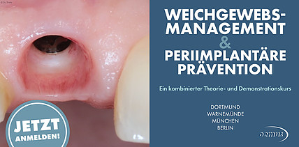 Perfekte Rot-Weiß-Ästhetik – nachhaltiger Implantaterfolg beginnt im Weichgewebe