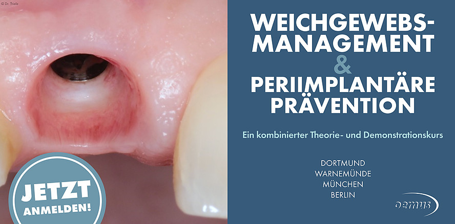 Perfekte Rot-Weiß-Ästhetik – nachhaltiger Implantaterfolg beginnt im Weichgewebe