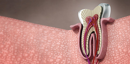Marginaler Knochenverlust erhöht Risiko endodontischer Komplikationen