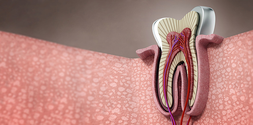 Marginaler Knochenverlust erhöht Risiko endodontischer Komplikationen
