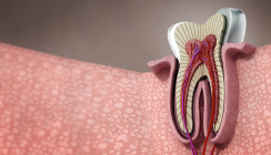 Marginaler Knochenverlust erhöht Risiko endodontischer Komplikationen