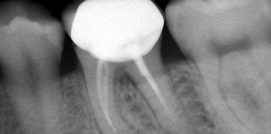 Bioceramics in der Endodontie