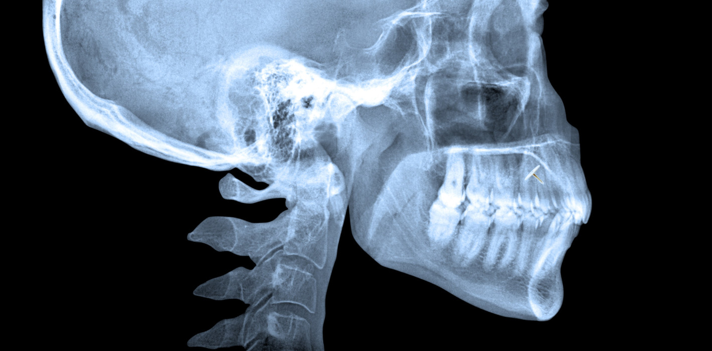 OPG beim Zahnarzt entlarvt heimliches Piercing-Experiment einer 13-Jährigen