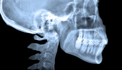 OPG beim Zahnarzt entlarvt heimliches Piercing-Experiment einer 13-Jährigen