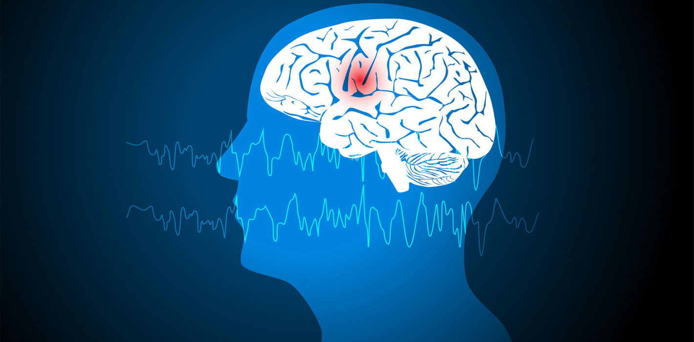 Zahnbehandlung und Epilepsie: Die richtige Vorbereitung