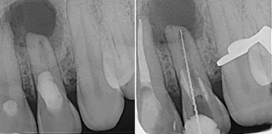 Zahnerhalt eines Oberkieferfrontzahnes trotz ausgeprägter Osteolyse