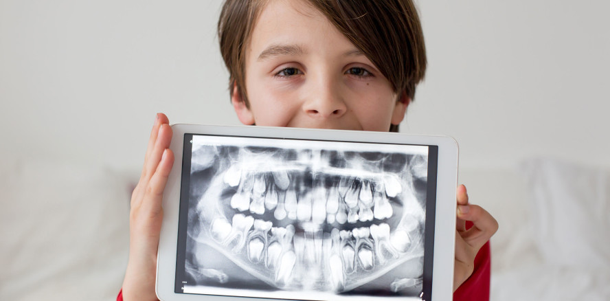 Zahnfehlstellungen erhöhen das Risiko für Plaque und Karies