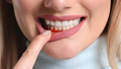 Zahnfleischbluten kann Zeichen von Vitamin-C-Mangel sein