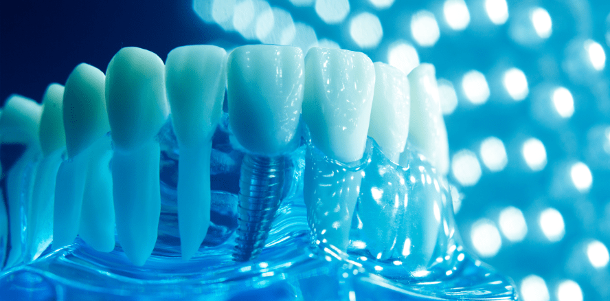 Implantate versagen häufiger bei Menschen mit Penicillin-Allergie