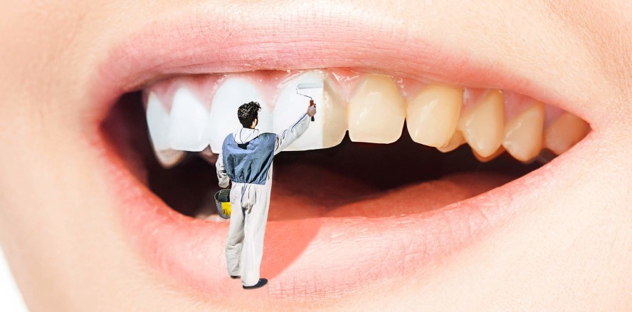 Zahnschmelzfreundliches Bleichgel entwickelt