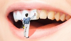 Zahnschmelzfreundliches Bleichgel entwickelt