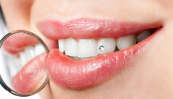 Dentales Comeback! Zahnschmuck erlebt Revival