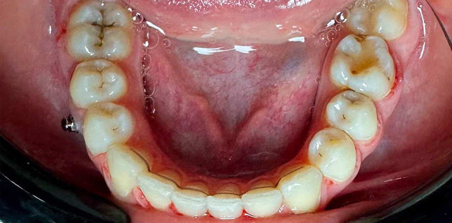 Zahnverschiebung: Eine effektive Alternative zur Implantation