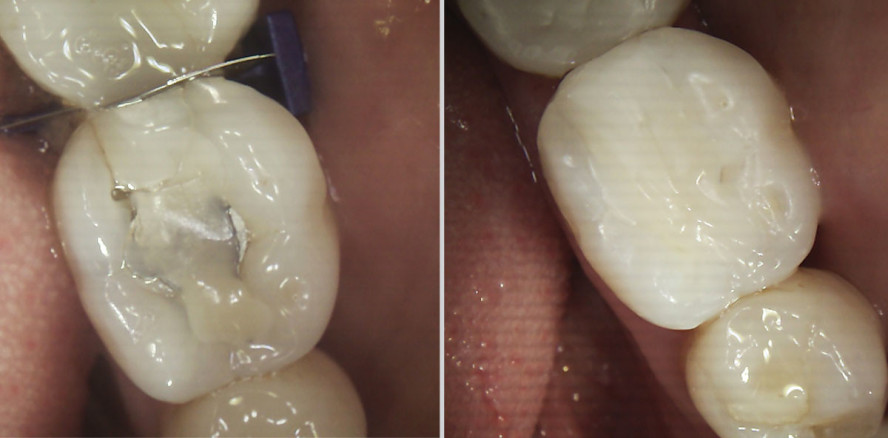 Bulk EZ das perfekte Bulk-Fill-Material, um Dentin nachzuahmen