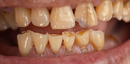 Weniger Biss, mehr Gewicht? Zahnverlust erhöht Risiko für Gewichtszunahme im Alter