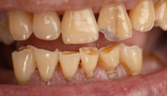 Weniger Biss, mehr Gewicht? Zahnverlust erhöht Risiko für Gewichtszunahme im Alter