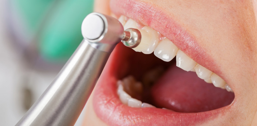 Umfrage gestartet: Zuschuss zur Professionellen Zahnreinigung