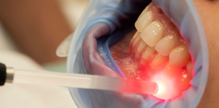 Photobiomodulation lindert Zahnfleischentzündung während Chemotherapie