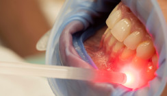Photobiomodulation lindert Zahnfleischentzündung während Chemotherapie